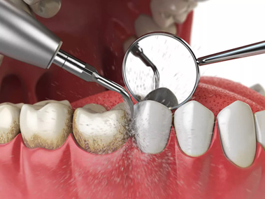 Check Ups Cleans Root Canal Treatment