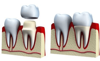 Root Canal Treatment