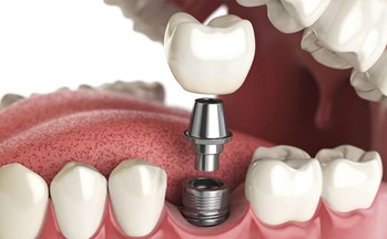 Dental Implants Root Canal Treatment
