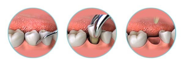 Extractions Root Canal Treatment